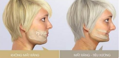 Niềng răng bị hóp má